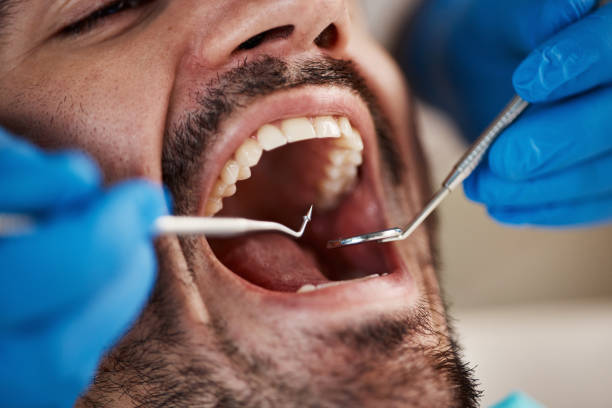 Best Emergency Wisdom Teeth Removal in Victoria, TX